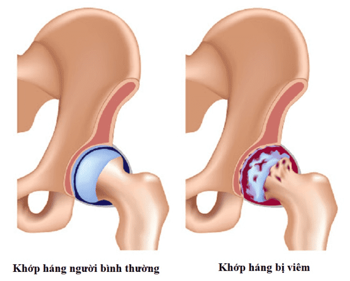 Viêm khớp háng là tình trạng do sự bào mòn của xương sụn xung quanh khớp
