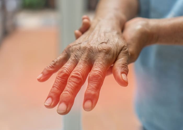Viêm khớp ngón tay là gì? nguyên nhân triệu chứng của bệnh