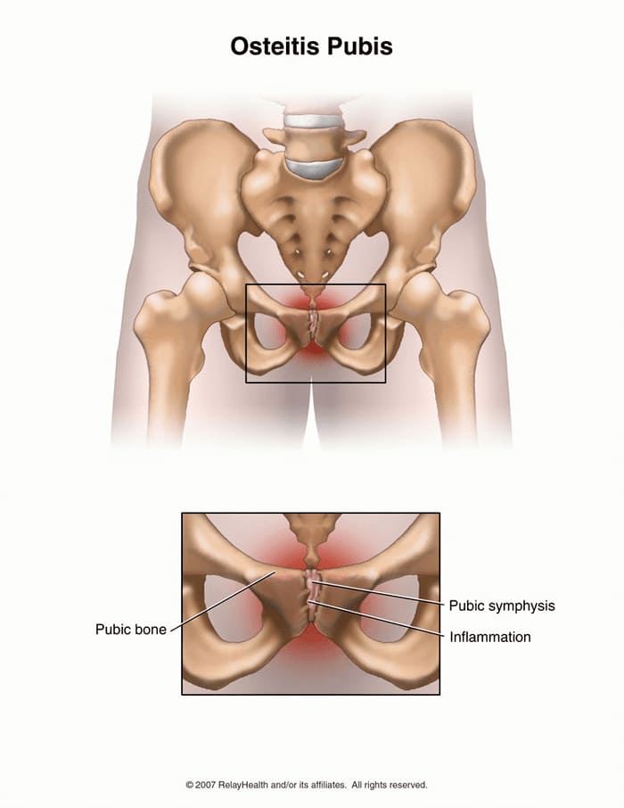 Viêm xương Pubis có thể gây đau khớp háng